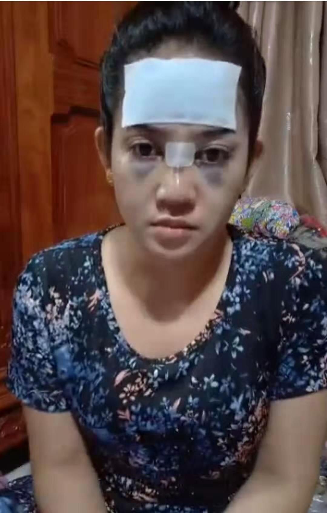 惨不忍睹！柬埔寨一女星整容不成反变“熊猫眼”……-3.jpg