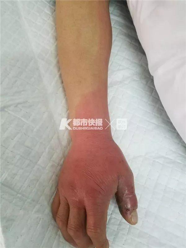 浙江男子被眼镜蛇咬伤，挤出毒血后再跟朋友去喝了个酒！-2.jpg