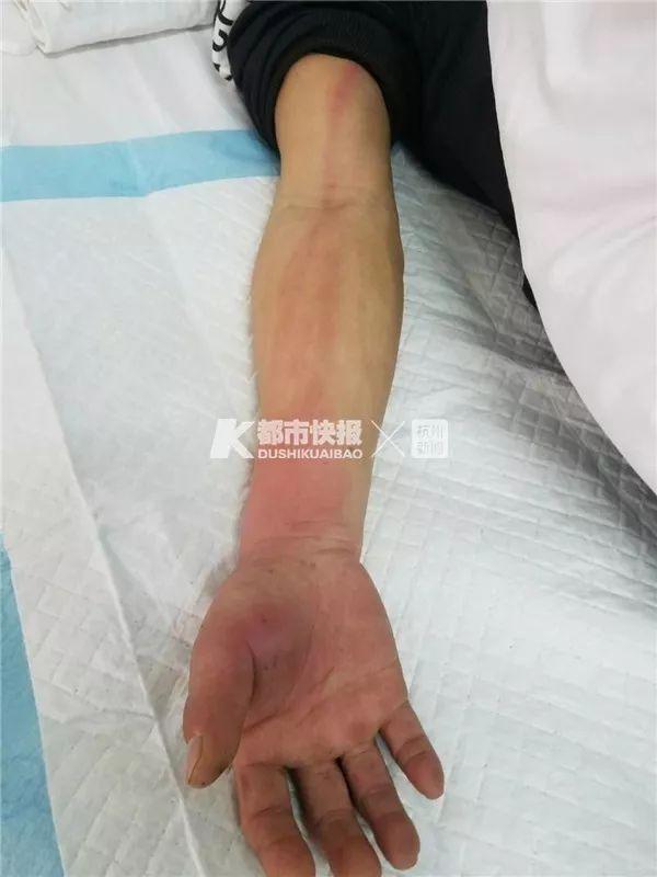 浙江男子被眼镜蛇咬伤，挤出毒血后再跟朋友去喝了个酒！-3.jpg