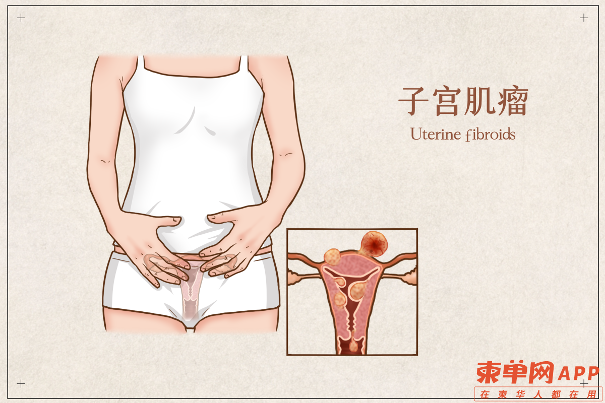 子宫肌瘤.png